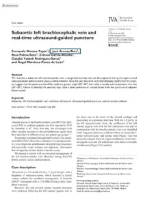 Artículo Subaortic left brachiocephalic vein and real-time ultrasound-guided puncture